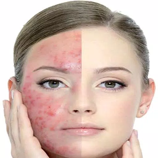 Get Rid of Acne  (Guide) Captura de pantalla 1